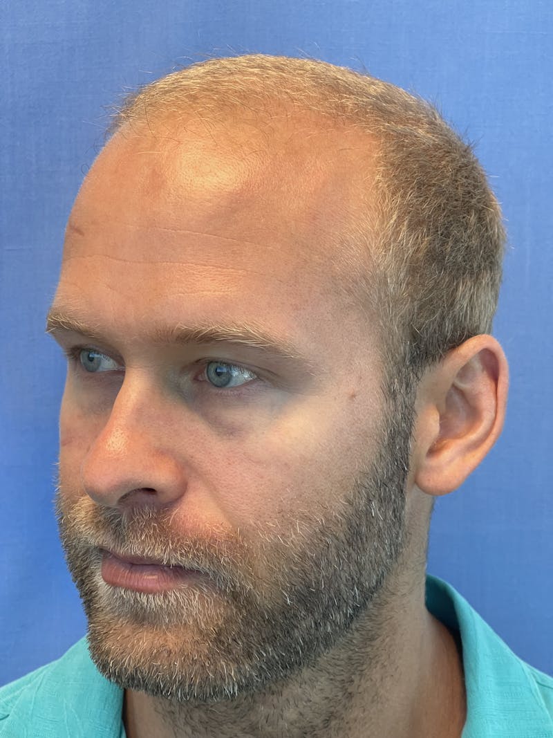 Surgical Before & After Gallery - Patient 63988803 - Image 5