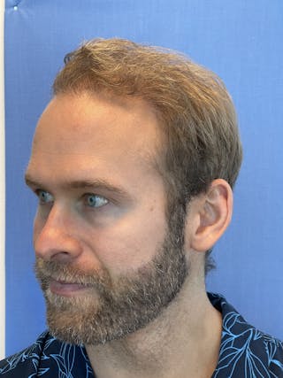 Surgical Before & After Gallery - Patient 63988803 - Image 6