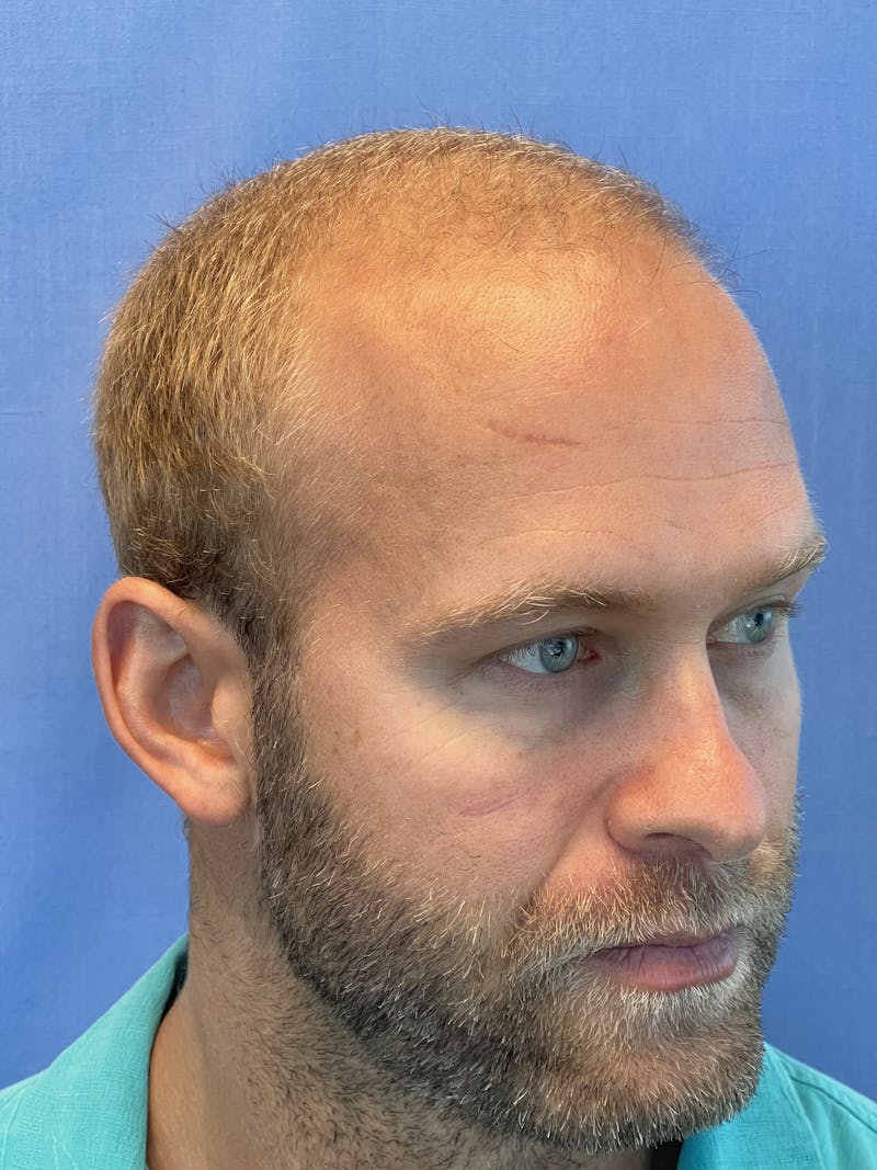 Surgical Before & After Gallery - Patient 63988803 - Image 7