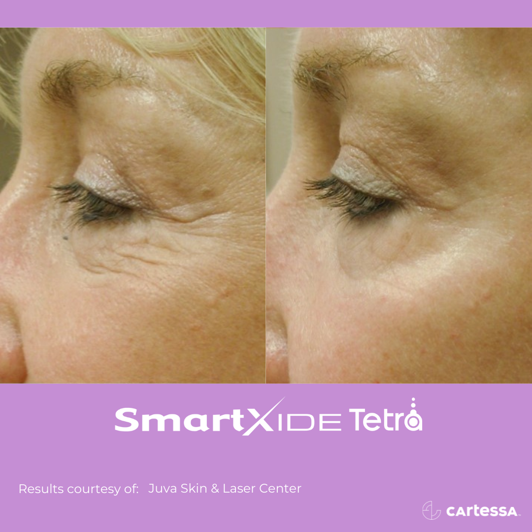 Before & after pic of SmartXide Tetra
