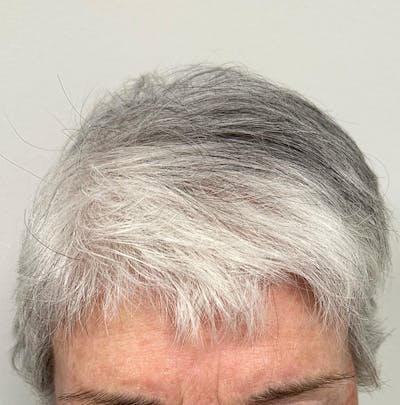 Non-Surgical Before & After Gallery - Patient 335041 - Image 2