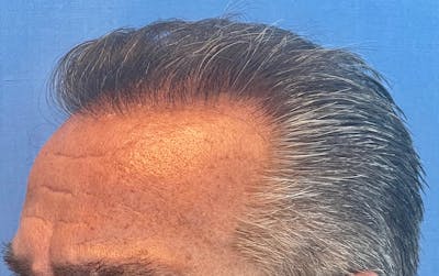 Non-Surgical Before & After Gallery - Patient 140420 - Image 2