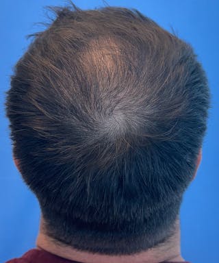 Non-Surgical Before & After Gallery - Patient 204240 - Image 2
