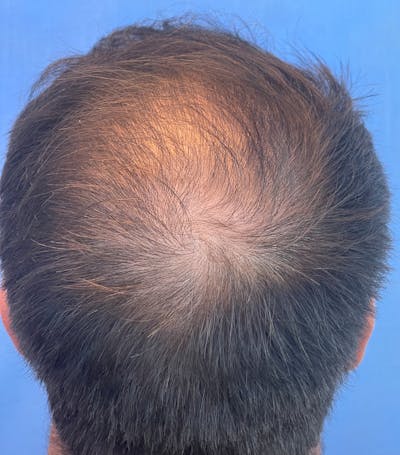 Non-Surgical Before & After Gallery - Patient 204240 - Image 1