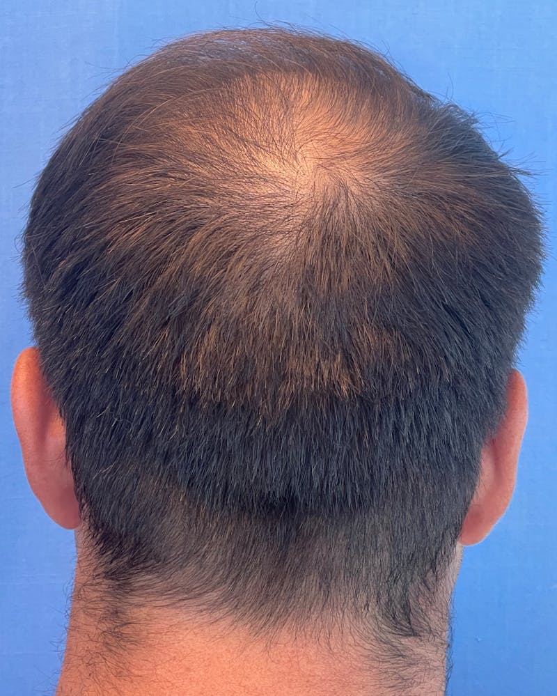 Non-Surgical Before & After Gallery - Patient 204240 - Image 6