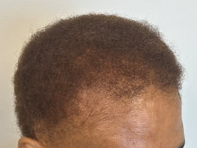 Non-Surgical Before & After Gallery - Patient 467589 - Image 6