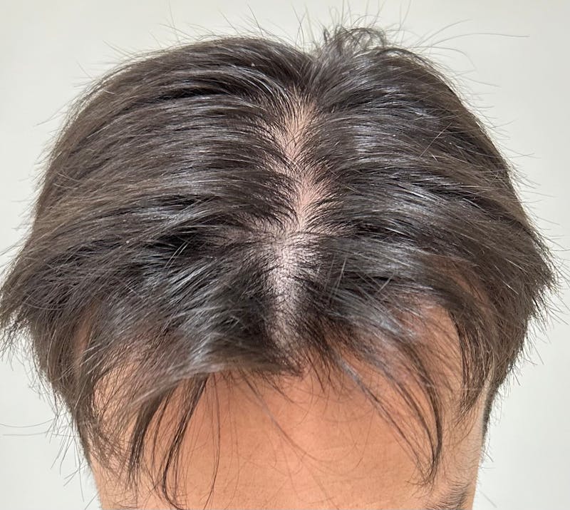 Non-Surgical Before & After Gallery - Patient 662175 - Image 2