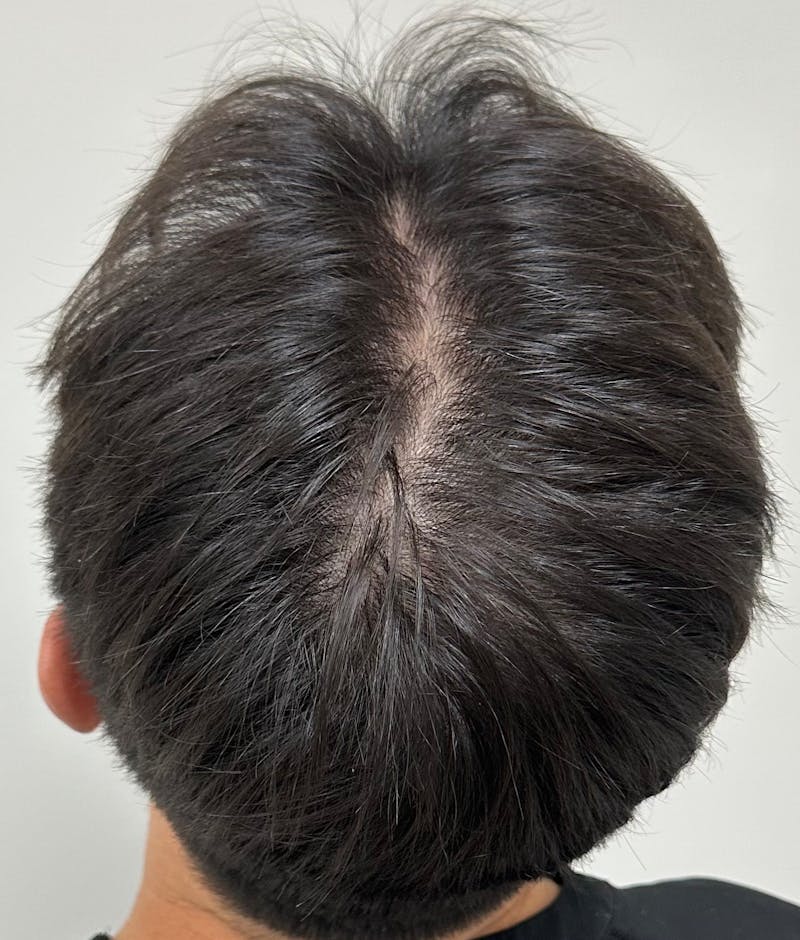 Non-Surgical Before & After Gallery - Patient 662175 - Image 3