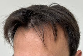 Non-Surgical Before & After Gallery - Patient 662175 - Image 10