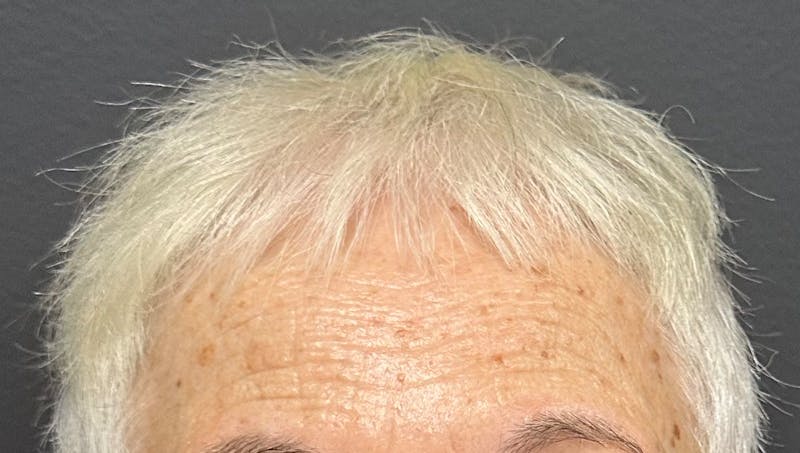 Non-Surgical Before & After Gallery - Patient 412991 - Image 1