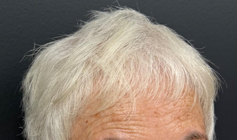 Non-Surgical Before & After Gallery - Patient 412991 - Image 6