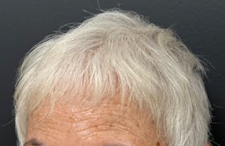 Non-Surgical Before & After Gallery - Patient 412991 - Image 4