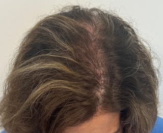 Non-Surgical Before & After Gallery - Patient 296124 - Image 4