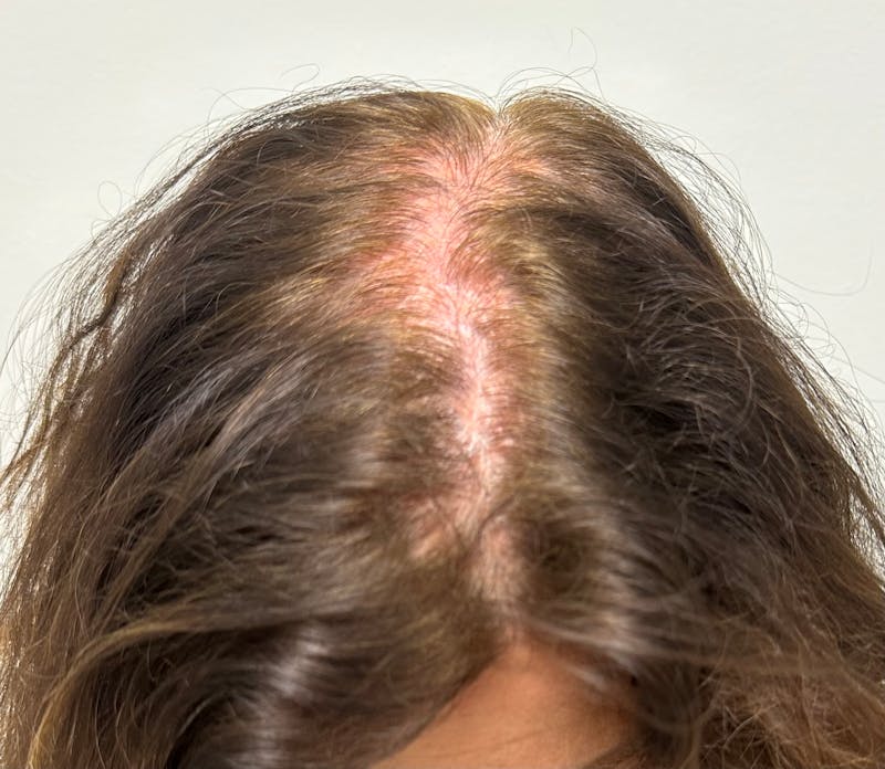 Non-Surgical Before & After Gallery - Patient 296124 - Image 3