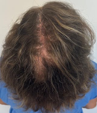 Non-Surgical Before & After Gallery - Patient 296124 - Image 2
