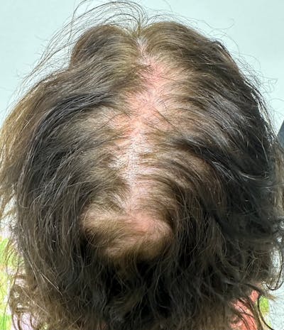 Non-Surgical Before & After Gallery - Patient 296124 - Image 1