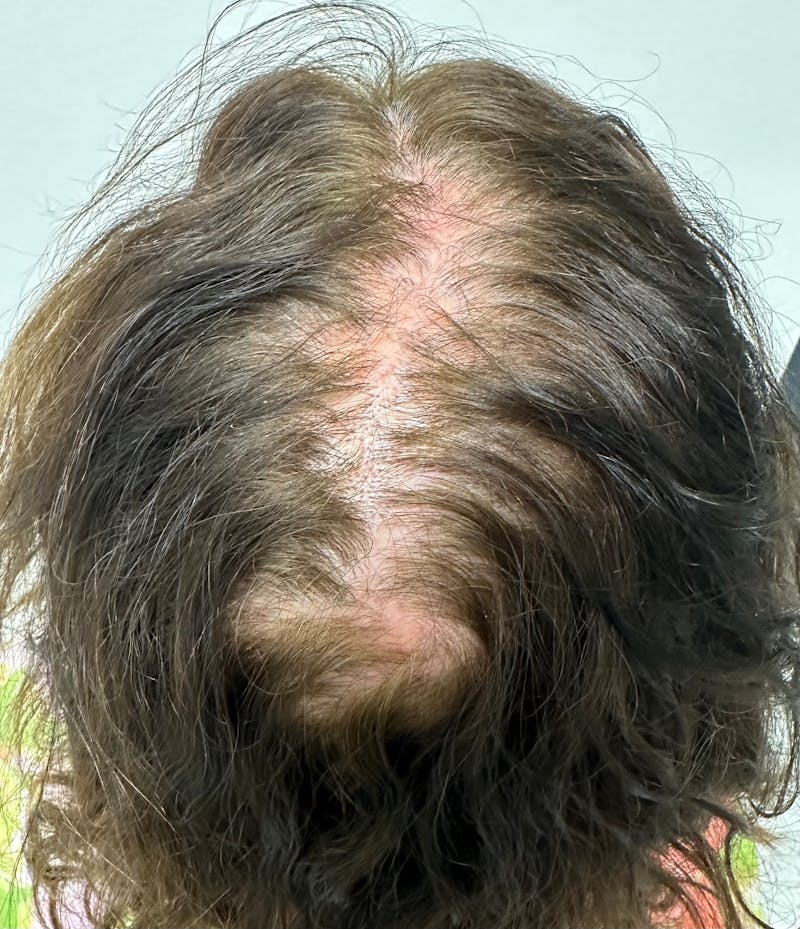 Non-Surgical Before & After Gallery - Patient 296124 - Image 1