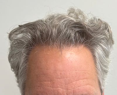 Non-Surgical Before & After Gallery - Patient 113958 - Image 2