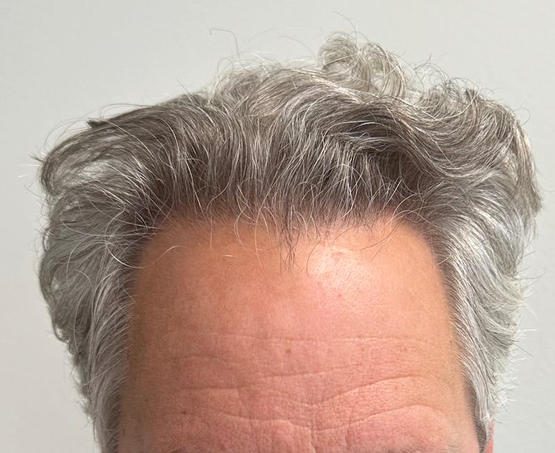 Non-Surgical Before & After Gallery - Patient 113958 - Image 2