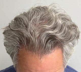 Non-Surgical Before & After Gallery - Patient 113958 - Image 4