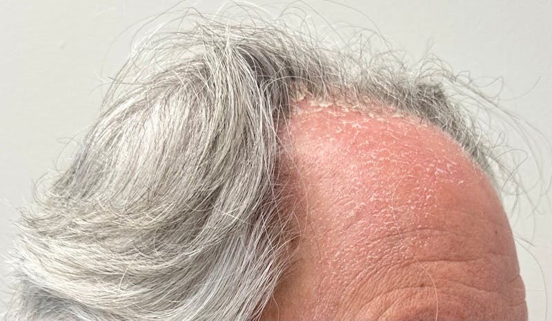 Non-Surgical Before & After Gallery - Patient 113958 - Image 5