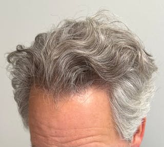 Non-Surgical Before & After Gallery - Patient 113958 - Image 8