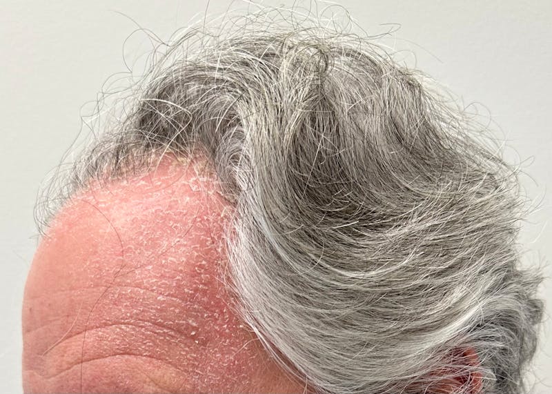 Non-Surgical Before & After Gallery - Patient 113958 - Image 7