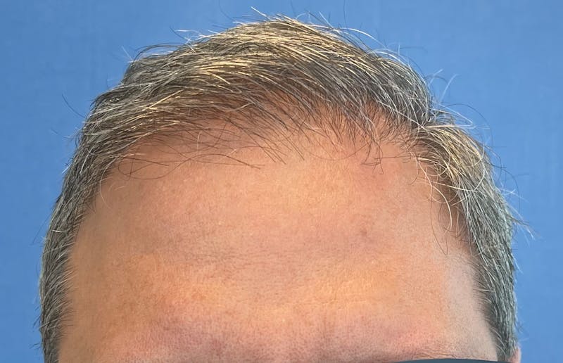 Non-Surgical Before & After Gallery - Patient 107614 - Image 1