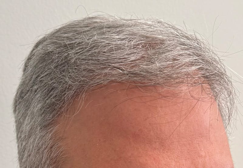 Non-Surgical Before & After Gallery - Patient 107614 - Image 4