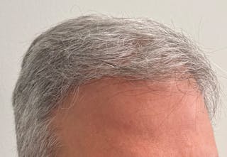 Non-Surgical Before & After Gallery - Patient 107614 - Image 4