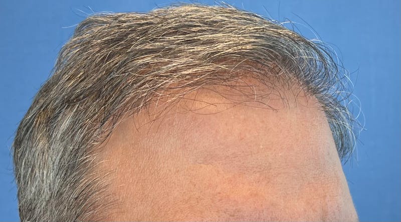 Non-Surgical Before & After Gallery - Patient 107614 - Image 3