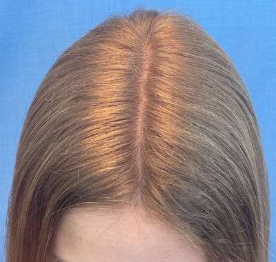 Non-Surgical Before & After Gallery - Patient 308661 - Image 2