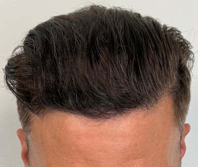 Surgical Before & After Gallery - Patient 152070 - Image 2