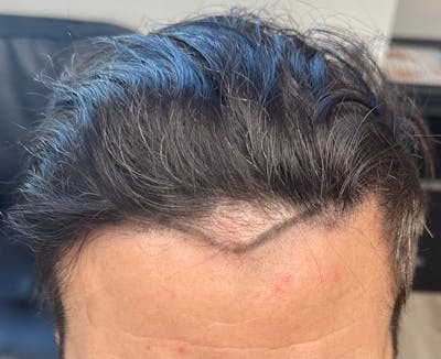 Surgical Before & After Gallery - Patient 152070 - Image 1