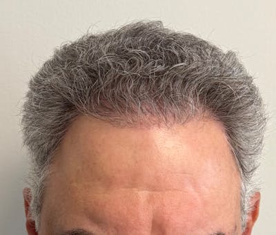 Surgical Before & After Gallery - Patient 193842 - Image 2