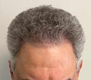 Surgical Before & After Gallery - Patient 193842 - Image 4