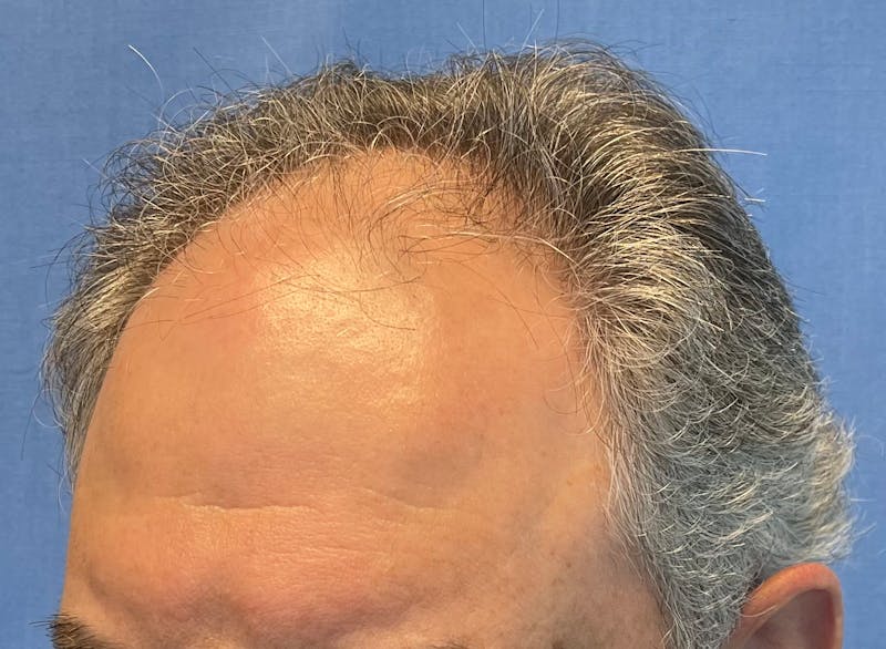 Surgical Before & After Gallery - Patient 193842 - Image 5