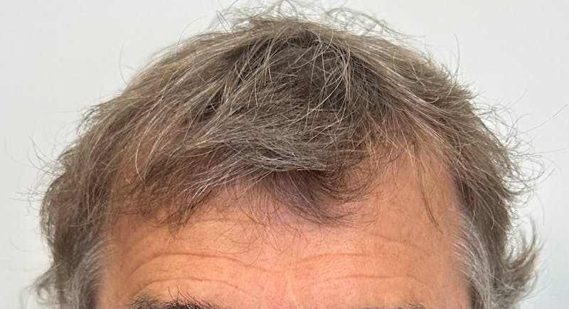 Surgical Before & After Gallery - Patient 246729 - Image 4