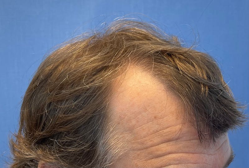 Surgical Before & After Gallery - Patient 246729 - Image 5