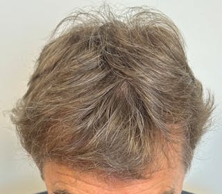 Surgical Before & After Gallery - Patient 246729 - Image 2