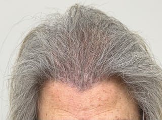 Surgical Before & After Gallery - Patient 586558 - Image 2