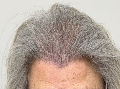 Surgical Before & After Gallery - Patient 586558 - Image 2