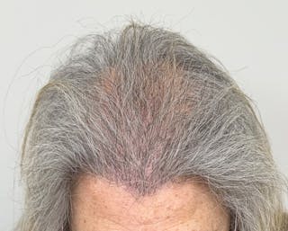 Surgical Before & After Gallery - Patient 586558 - Image 10