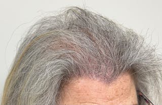 Surgical Before & After Gallery - Patient 586558 - Image 6