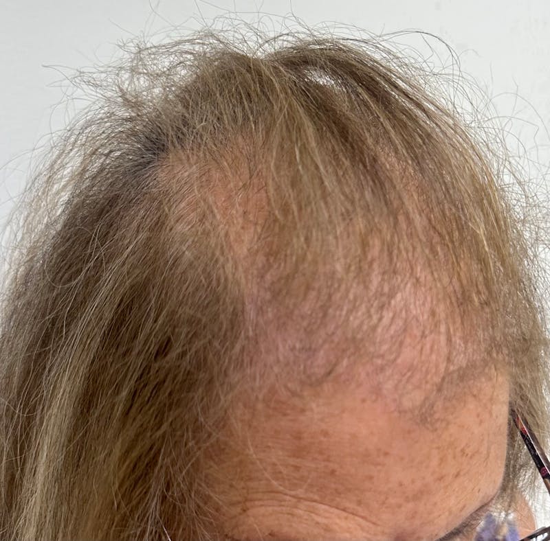 Surgical Before & After Gallery - Patient 586558 - Image 5