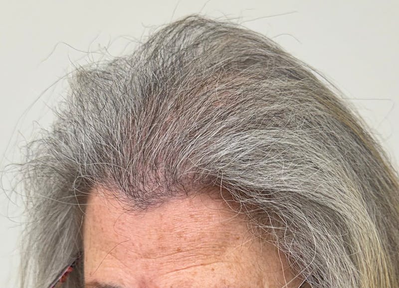 Surgical Before & After Gallery - Patient 586558 - Image 8