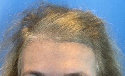 Non-Surgical Before & After Gallery - Patient 423058 - Image 1