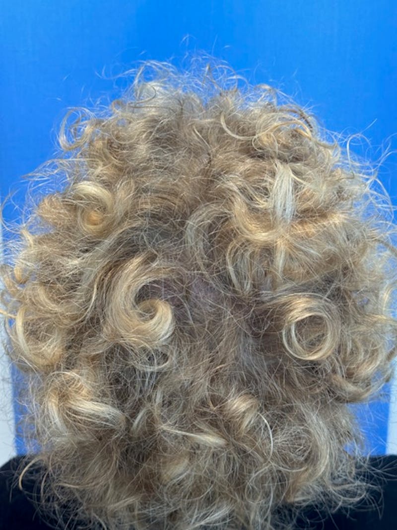 Non-Surgical Before & After Gallery - Patient 423058 - Image 8