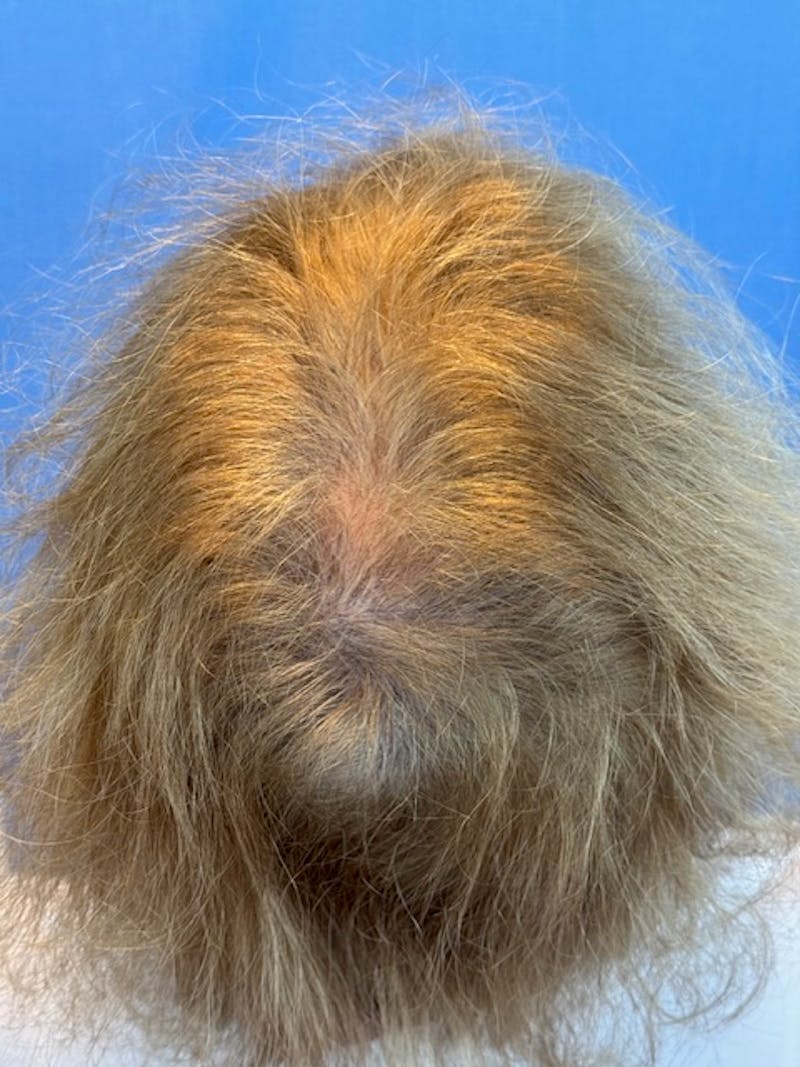 Non-Surgical Before & After Gallery - Patient 423058 - Image 5