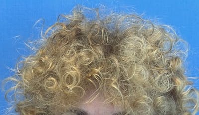 Non-Surgical Before & After Gallery - Patient 423058 - Image 2